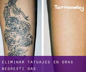 Eliminar tatuajes en Oraş Negreşti-Oaş