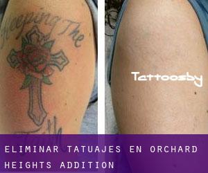 Eliminar tatuajes en Orchard Heights Addition
