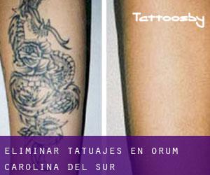 Eliminar tatuajes en Orum (Carolina del Sur)