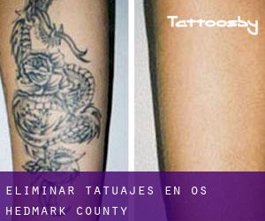 Eliminar tatuajes en Os (Hedmark county)
