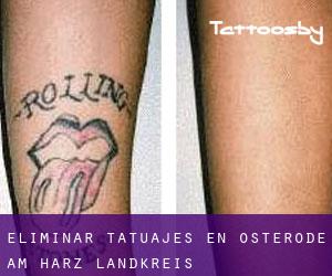 Eliminar tatuajes en Osterode am Harz Landkreis