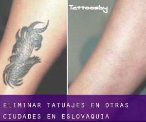 Eliminar tatuajes en Otras Ciudades en Eslovaquia