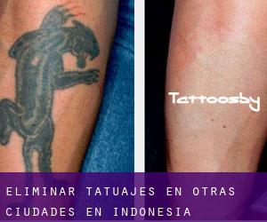 Eliminar tatuajes en Otras Ciudades en Indonesia