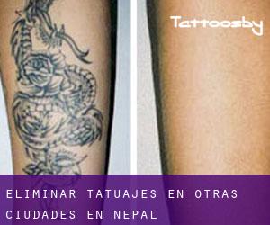 Eliminar tatuajes en Otras Ciudades en Nepal