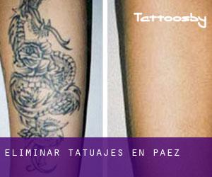 Eliminar tatuajes en Páez