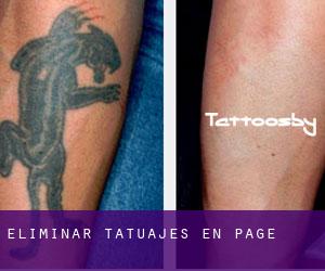 Eliminar tatuajes en Page