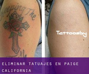 Eliminar tatuajes en Paige (California)