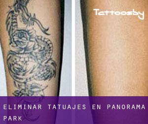 Eliminar tatuajes en Panorama Park