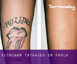 Eliminar tatuajes en Paola