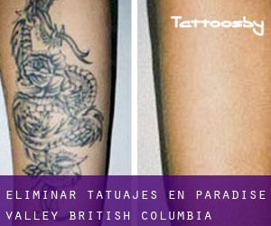 Eliminar tatuajes en Paradise Valley (British Columbia)