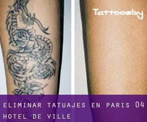 Eliminar tatuajes en Paris 04 Hôtel-de-Ville