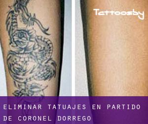 Eliminar tatuajes en Partido de Coronel Dorrego