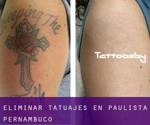 Eliminar tatuajes en Paulista (Pernambuco)