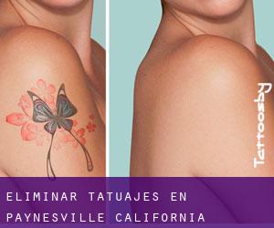 Eliminar tatuajes en Paynesville (California)