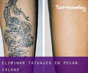 Eliminar tatuajes en Pecan Island