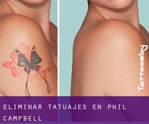 Eliminar tatuajes en Phil Campbell