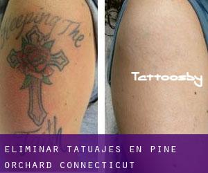 Eliminar tatuajes en Pine Orchard (Connecticut)