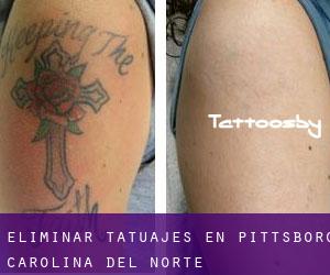 Eliminar tatuajes en Pittsboro (Carolina del Norte)