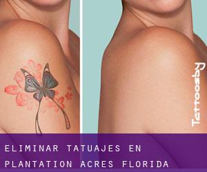 Eliminar tatuajes en Plantation Acres (Florida)