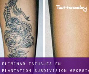 Eliminar tatuajes en Plantation Subdivision (Georgia)