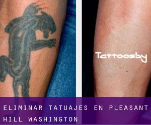 Eliminar tatuajes en Pleasant Hill (Washington)