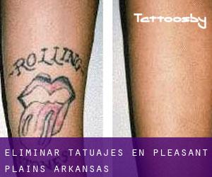 Eliminar tatuajes en Pleasant Plains (Arkansas)