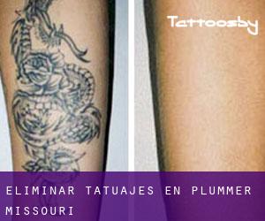Eliminar tatuajes en Plummer (Missouri)