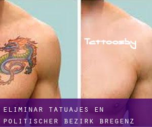 Eliminar tatuajes en Politischer Bezirk Bregenz