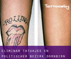 Eliminar tatuajes en Politischer Bezirk Dornbirn
