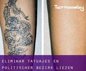 Eliminar tatuajes en Politischer Bezirk Liezen