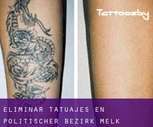 Eliminar tatuajes en Politischer Bezirk Melk