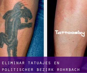 Eliminar tatuajes en Politischer Bezirk Rohrbach