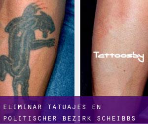 Eliminar tatuajes en Politischer Bezirk Scheibbs