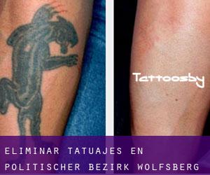 Eliminar tatuajes en Politischer Bezirk Wolfsberg