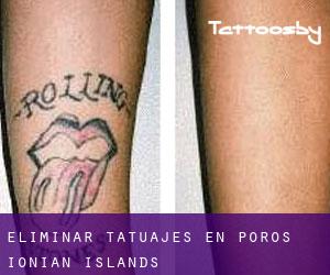 Eliminar tatuajes en Póros (Ionian Islands)