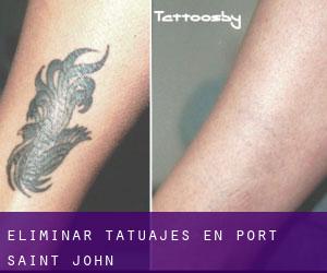 Eliminar tatuajes en Port Saint John