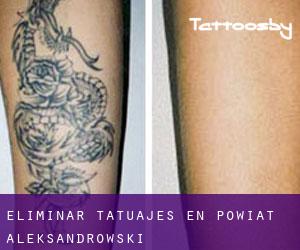 Eliminar tatuajes en Powiat aleksandrowski