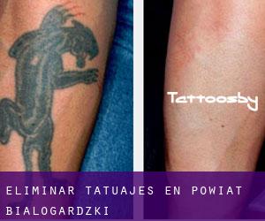Eliminar tatuajes en Powiat białogardzki
