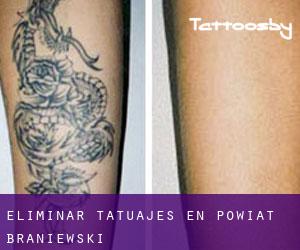 Eliminar tatuajes en Powiat braniewski