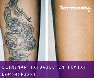 Eliminar tatuajes en Powiat nowomiejski