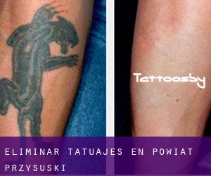 Eliminar tatuajes en Powiat przysuski