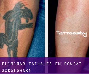 Eliminar tatuajes en Powiat sokołowski