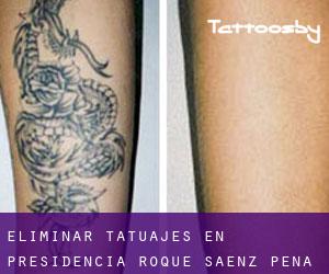 Eliminar tatuajes en Presidencia Roque Sáenz Peña