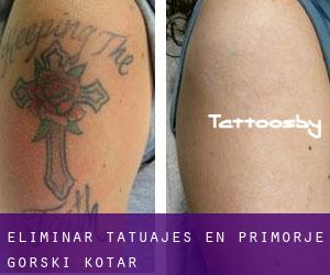 Eliminar tatuajes en Primorje - Gorski Kotar