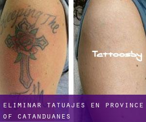 Eliminar tatuajes en Province of Catanduanes