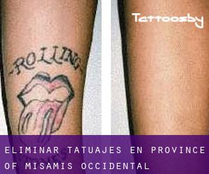 Eliminar tatuajes en Province of Misamis Occidental