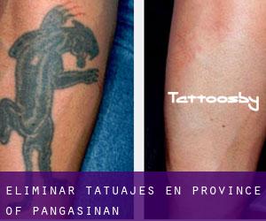Eliminar tatuajes en Province of Pangasinan