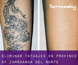 Eliminar tatuajes en Province of Zamboanga del Norte