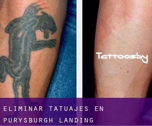 Eliminar tatuajes en Purysburgh Landing