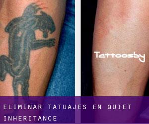 Eliminar tatuajes en Quiet Inheritance